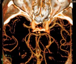 OCLUSIÓN DE ARTERIA CEREBRAL MEDIA DERECHA SEGMENTO M1
