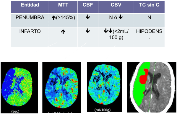Imagenangiotacperfusion