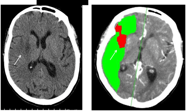 Imageninfarto establecido