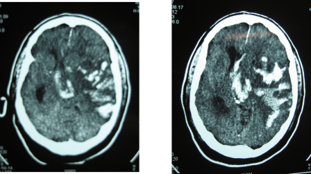 TAC CEREBRAL POST TROMBOLISIS HEMORRAGIA CEREBRAL 2