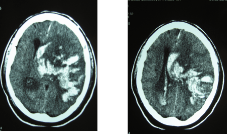 TAC CEREBRAL POST TROMBOLISIS HEMORRAGIA CEREBRAL 3