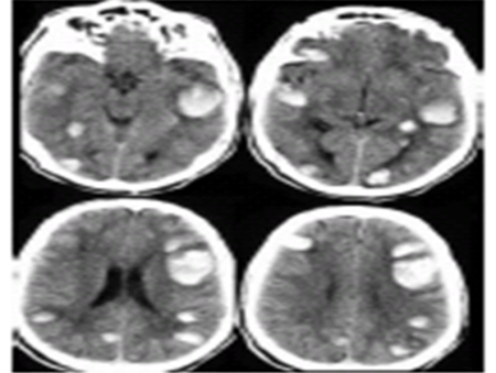 TAC CEREBRAL POST TROMBOLISIS HEMORRAGIA CEREBRAL 4