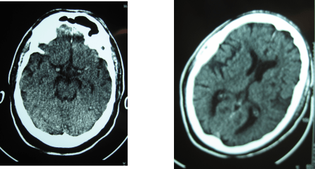 TAC CEREBRAL PRE TROMBOLISIS NORMAL 1