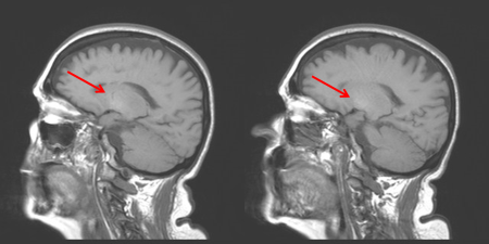 ENCEFALOPATIA HEPATICA RNM CEREBRAL