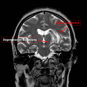 RNM CEREBRAL CORONAL DW.jpg