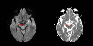 RNM CEREBRAL DIFUSIÓN ADC DW