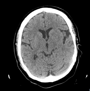TAC CEREBRAL NORMAL PREVIO DW