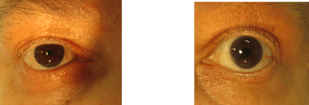 PTOSIS IZQUIERDA POST COLIRIO