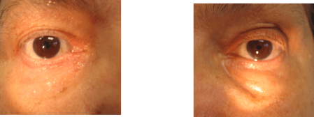 PTOSIS IZQUIERDA PRE COLIRIO