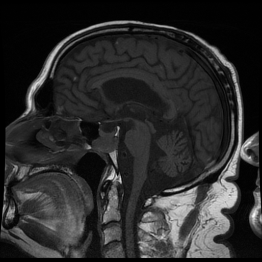 Adenoma de hipófisis invadiendo el seno esfenoidal
