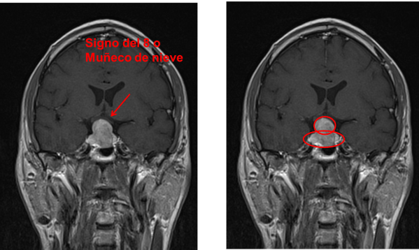 Adenoma de hipófisis. Signo del 8 o de muñeco de nieve.