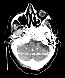Calcificaciones de los plexos coroideos en los recesos laterales del IV ventrículo.