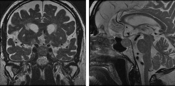Masa hipofisaria con compresión del quiasma
