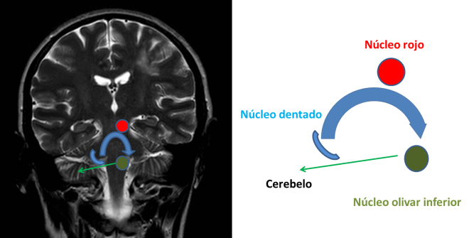 Circuito del"Triángulo de Mollaret".