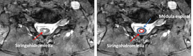 Imagen de una cavidad siringohidromiélica. En azul la médula. En rojo la cavidad