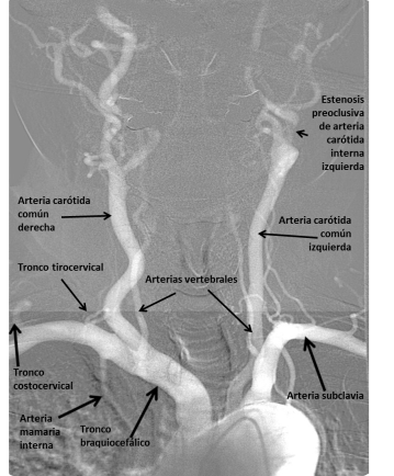 Arco aórtico y sus ramas principales.