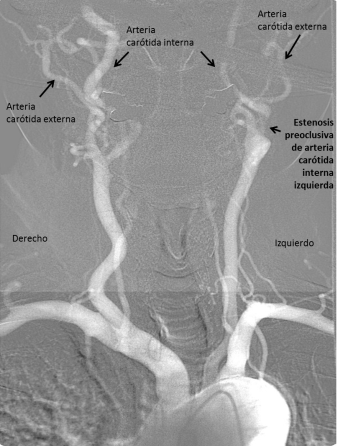 Arco Aórtico y sus ramas principales. Comparación del calibre de la arteria carótida interna y externa.
