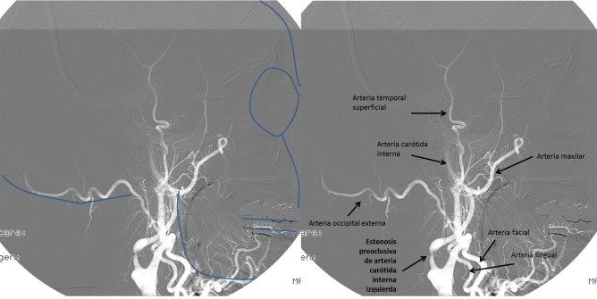 Figura 4. Arteriografía cerebral.Proyección lateral.