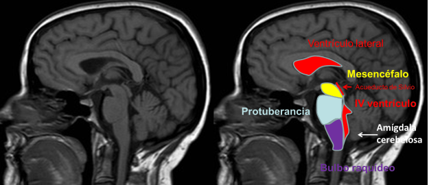 Imagen 1. RNM cerebral normal.