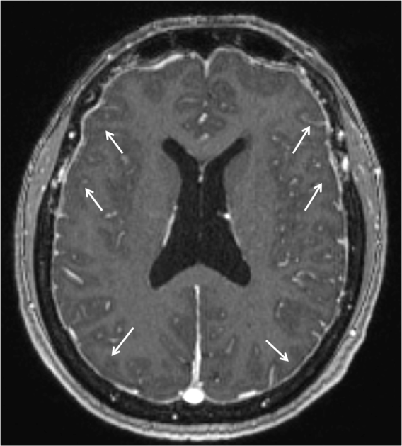 Imagen 7. Captación dural de contraste