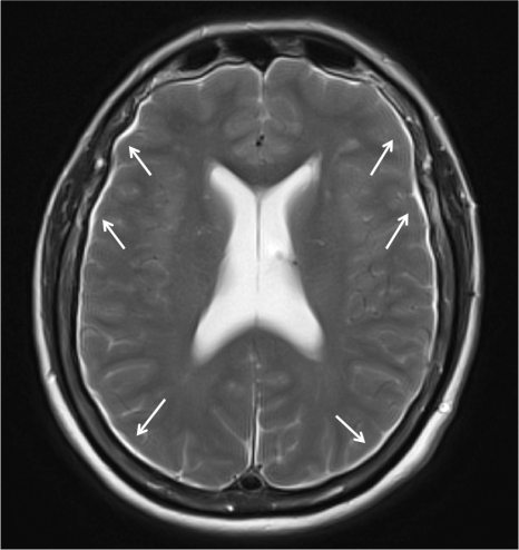 Imagen 2. Higromas subdurales bilaterales