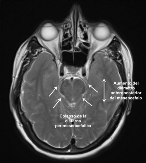 Imagen 3, colapso de cisternas perimesencefálicas.