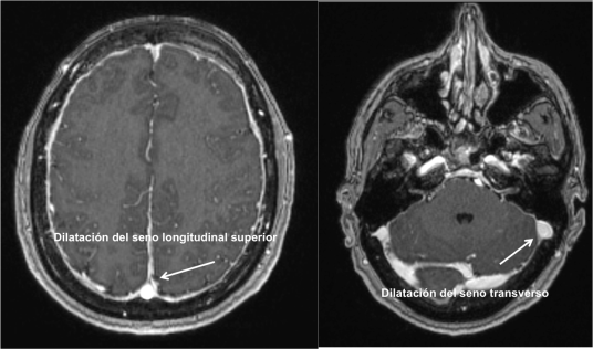 Dilatación de seno longitudinal y transverso