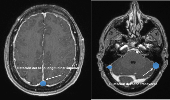 Dilatación de seno longitudinal y transverso