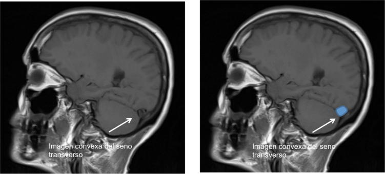 Imagen convexa del seno transverso