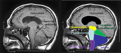 Imagen 3. Infarto cerebeloso con edema