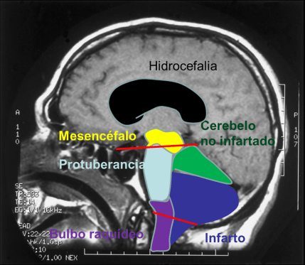 Línea incisural y de foramen magno y relación con las estructruas anatómicas.