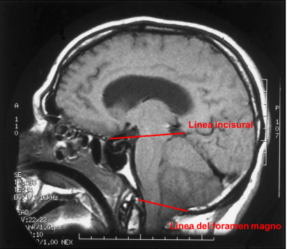 Línea incisural y línea del foramen magno
