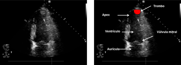 Trombo ventricular izquierdo