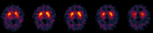DaTSCAN – consulta de neurologia