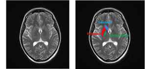 Localización de caudado, putamen y globo pálido