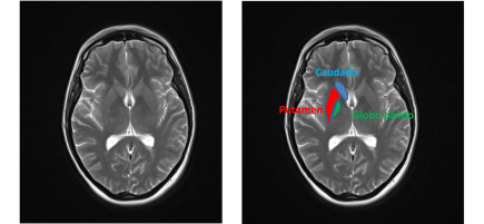 Localización de caudado, putamen y globo pálido