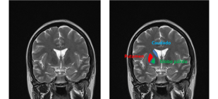 Localización de caudado, putamen y globo pálido