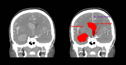 Hemorragia intraventricular primaria. Desviación de línea media.