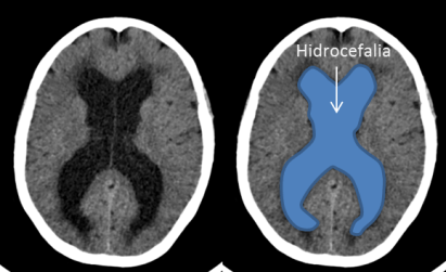 Hidrocefalia por quiste coloide del III ventrículo