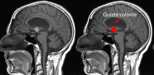 RNM QUISTE COLOIDE 1
