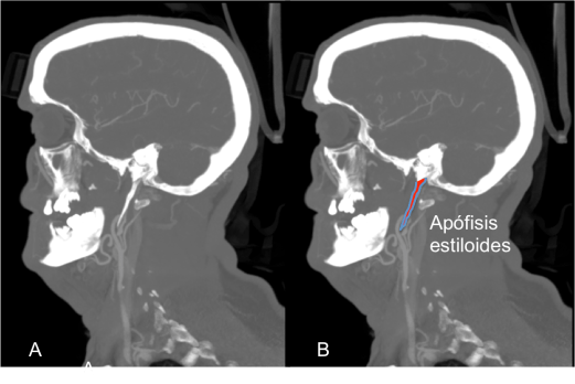 APÓFISIS ESTILOIDES 1
