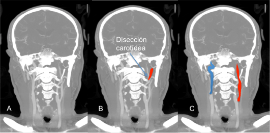 DISECCIÓN CAROTIDEA Y APOFISIS ESTILOIDES